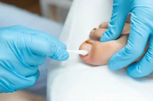 Ingrown Toenail