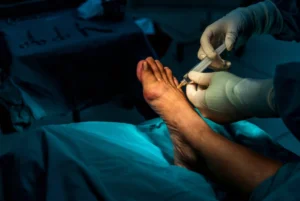 Bunion surgery recovery
