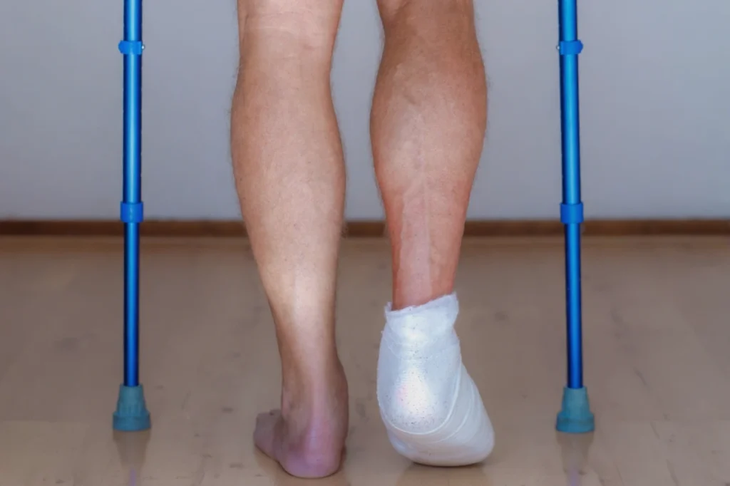 Bunion surgery recovery