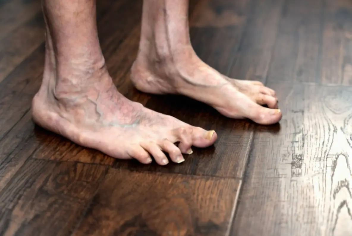 Hammertoe Relief: When Home Care Helps and When Surgery Is Needed