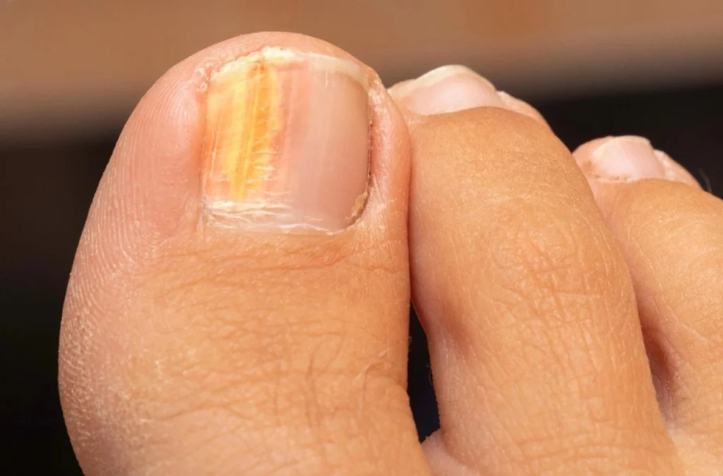Toe Infection
