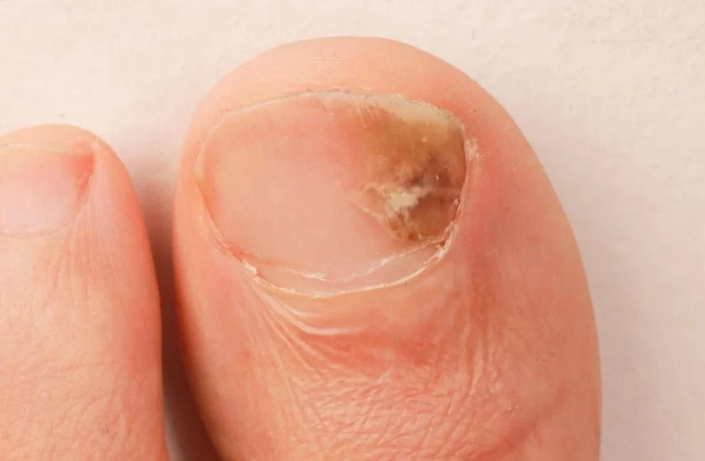 Toe Infection