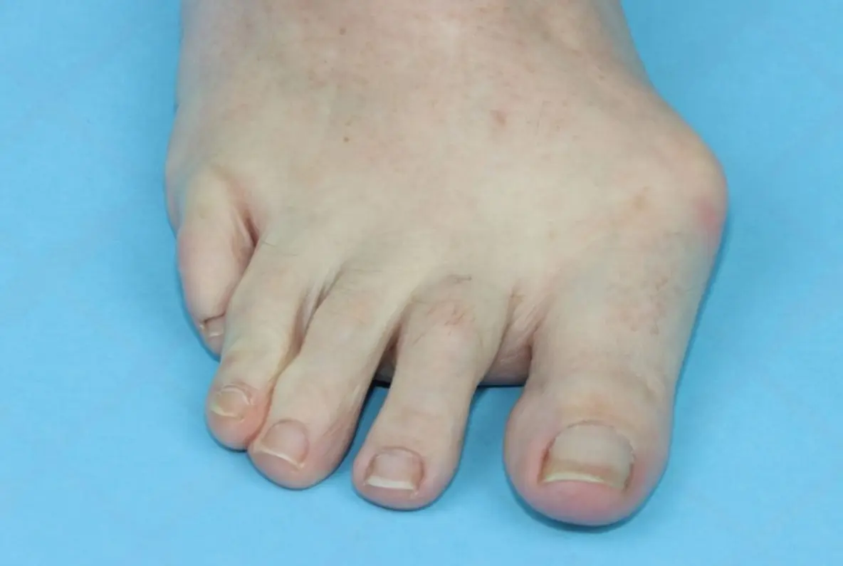 bunions and surgery