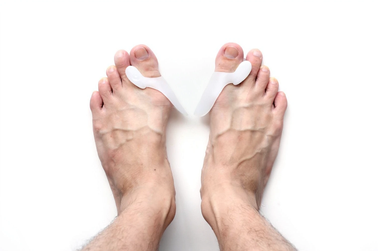 bunion causes